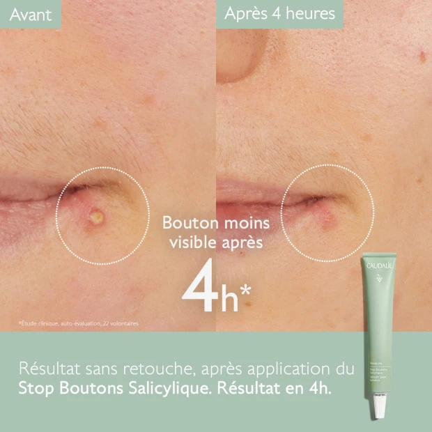 Caudalie Vinopure Stop Boutons Salycilique, 15ml 3 Caudalie Vinopure Stop Boutons Salycilique, 15ml – Image 3